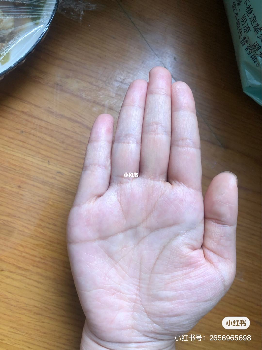十字手纹是心脏病的征兆